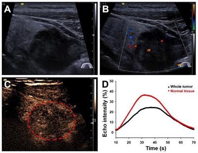 Contrast-Enhanced Ultrasound of Primary Squamous Cell Carcinoma of the Thyroid: A Case Report